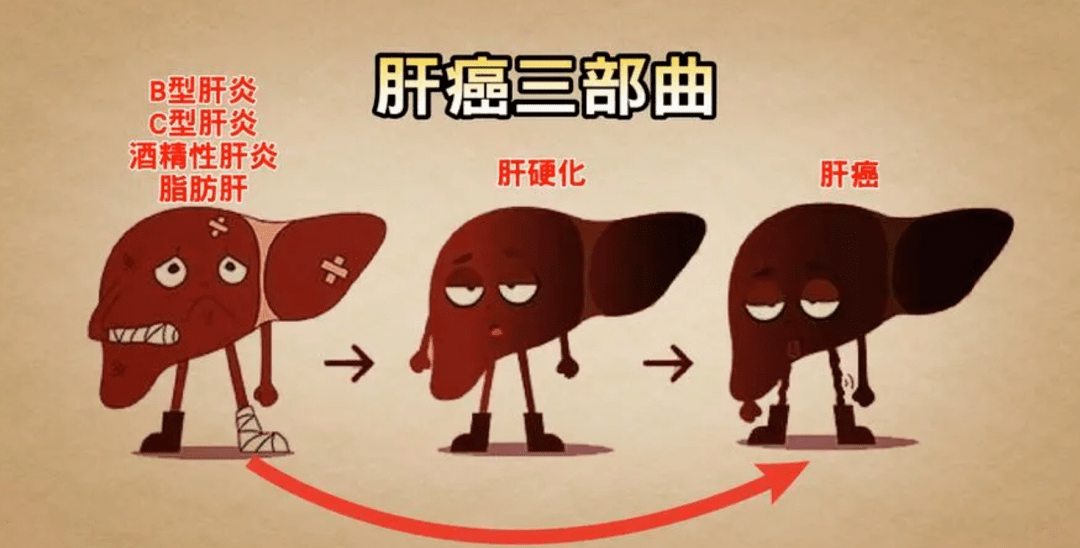 肝硬化微小肝癌不用怕,磁共振引导穿刺消灭它_肿瘤_治疗_病灶