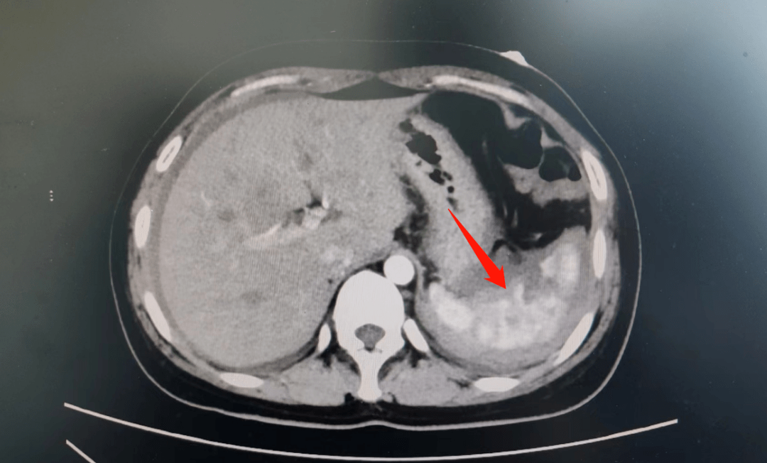 生死营救 | 女子骑车摔倒致脾脏破裂,沭医腹腔镜微创手术成功抢救