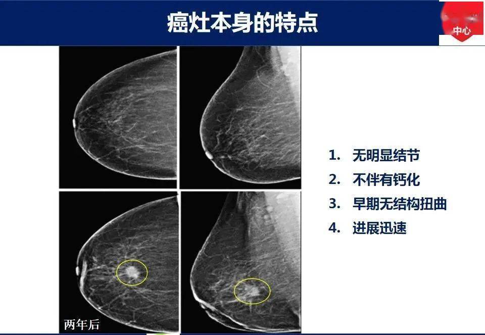 乳腺癌胸壁复发2例图片
