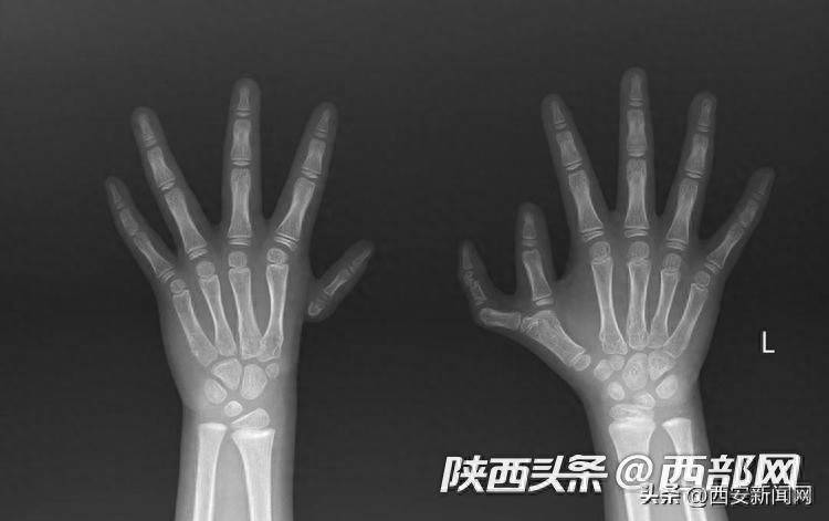 国内首例!西北妇幼成功为“六指姑娘”实施自体多指移植手术_拇指_右手掌_关节