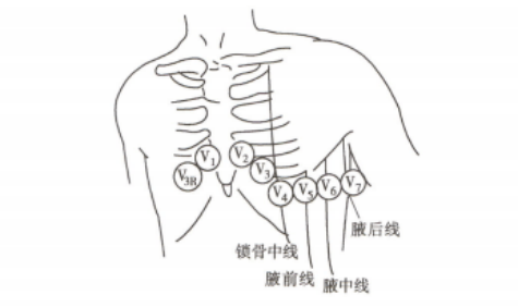 图4胸导联电极的放置（来源：《现代麻醉学》）v1：胸骨右缘第四肋间；v2