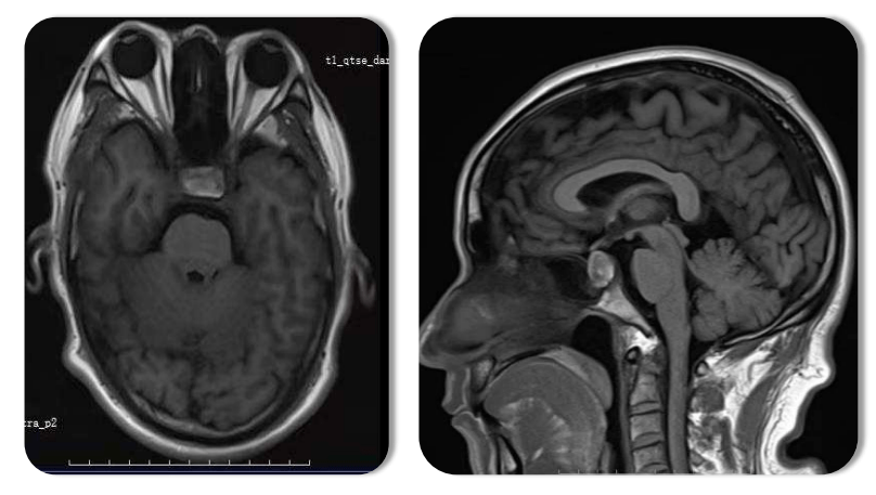 通过磁共振成像检查发现垂体瘤,手术治疗后视力视野均有好转.