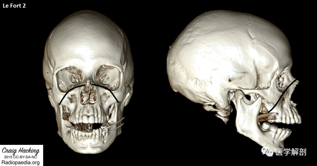 高级职称考点 | lefort骨折分型及图解盘点_上颌_fort_水平