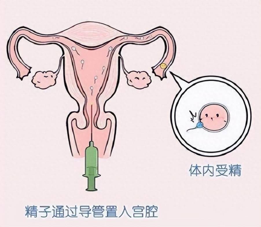 人工授精是指通过人工方法将男性精液注入女性生殖道内,以期待精子与