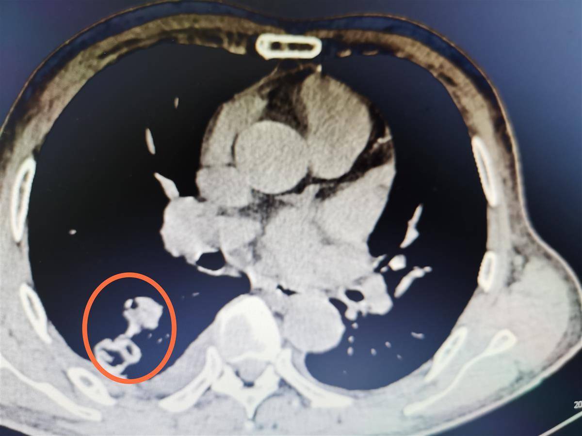 只吃了几次野生黄鳝,爹爹患上肺吸虫病_邓师傅_寄生虫_武汉市