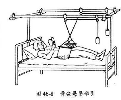 骨盆倾斜牵引图片