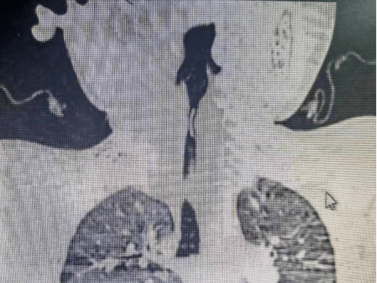 1岁宝宝吃鸡蛋后咳得厉害,脸色铁青…CT显示声门卡了块超薄“瓦片”,这究竟是什么?_贝贝_刘佳_孩子