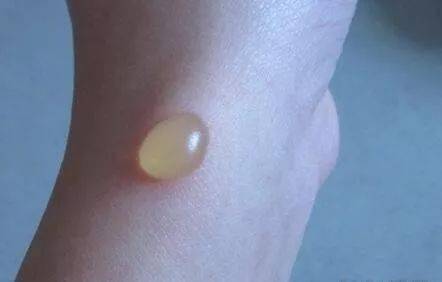 烫伤出现水泡时,要保护好水泡,尤其在渗出期,尽量不要抽吸渗液,可外涂