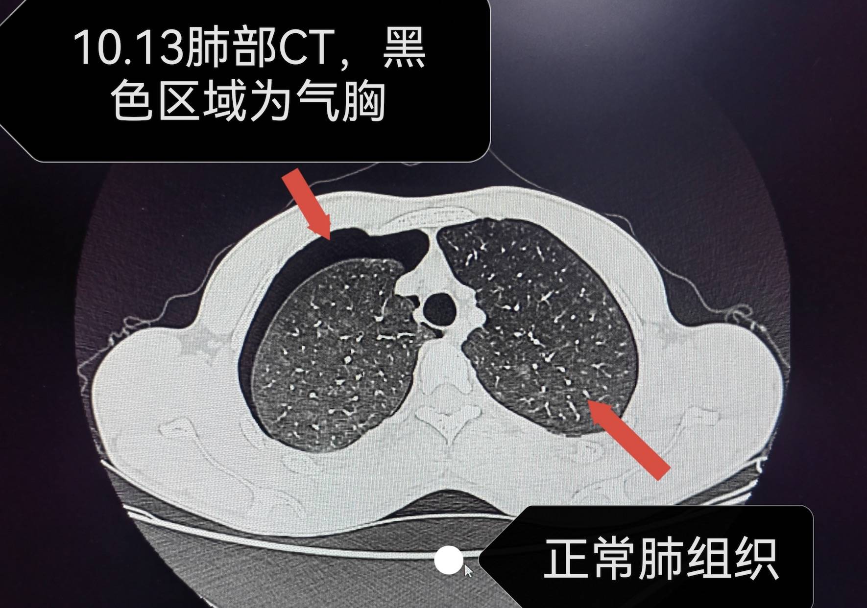 24岁小伙睡觉翻身后胸部剧痛，被诊断为气胸！这种病偏爱“竹竿男”_柳威_小胡_自发性