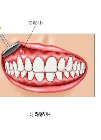 牙龈篓管图片