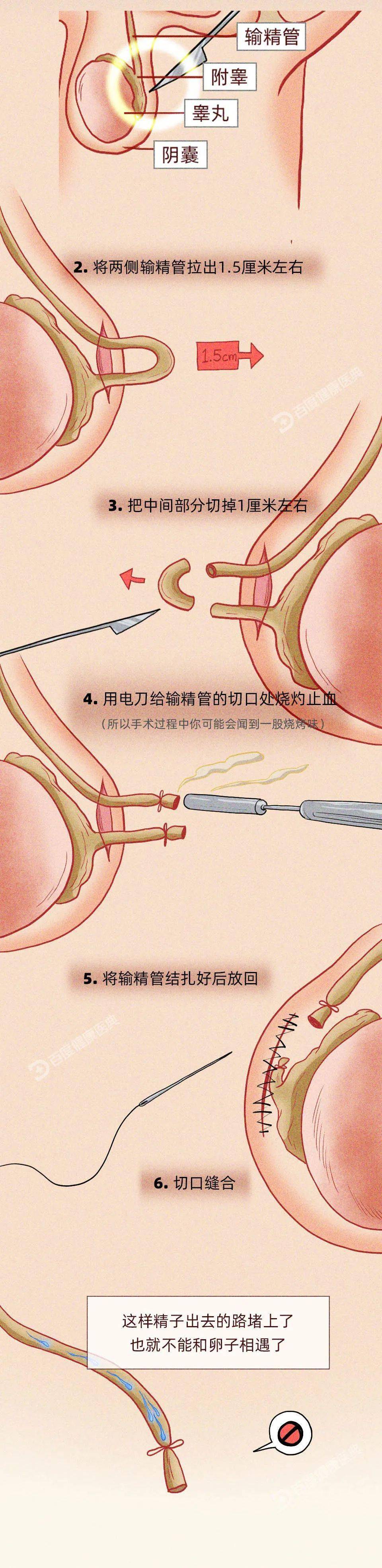 输精管结扎术新方法图片