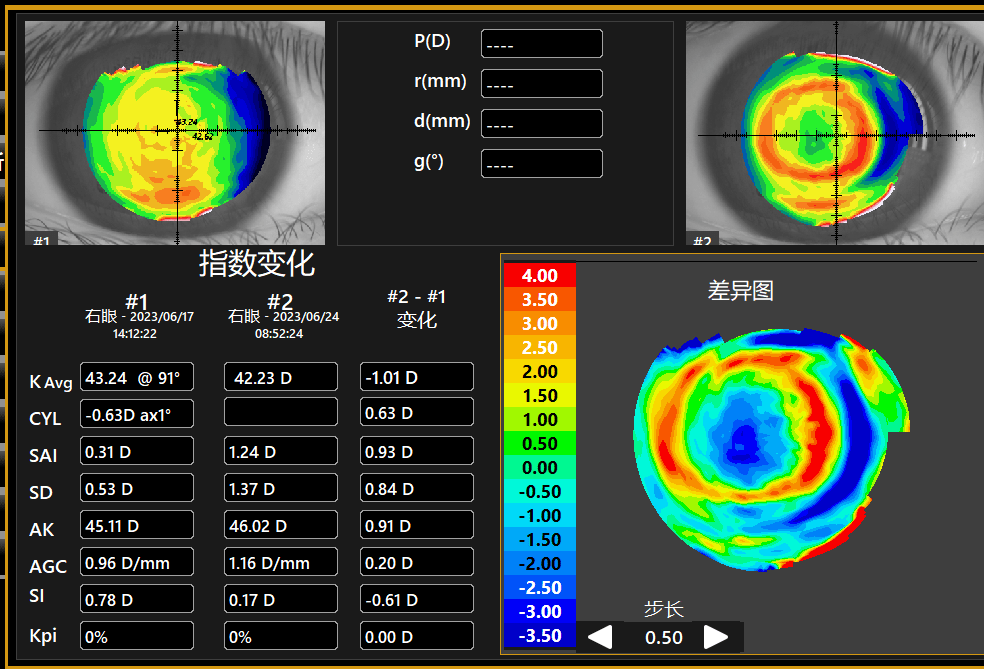 角膜地形图ks和kf图片