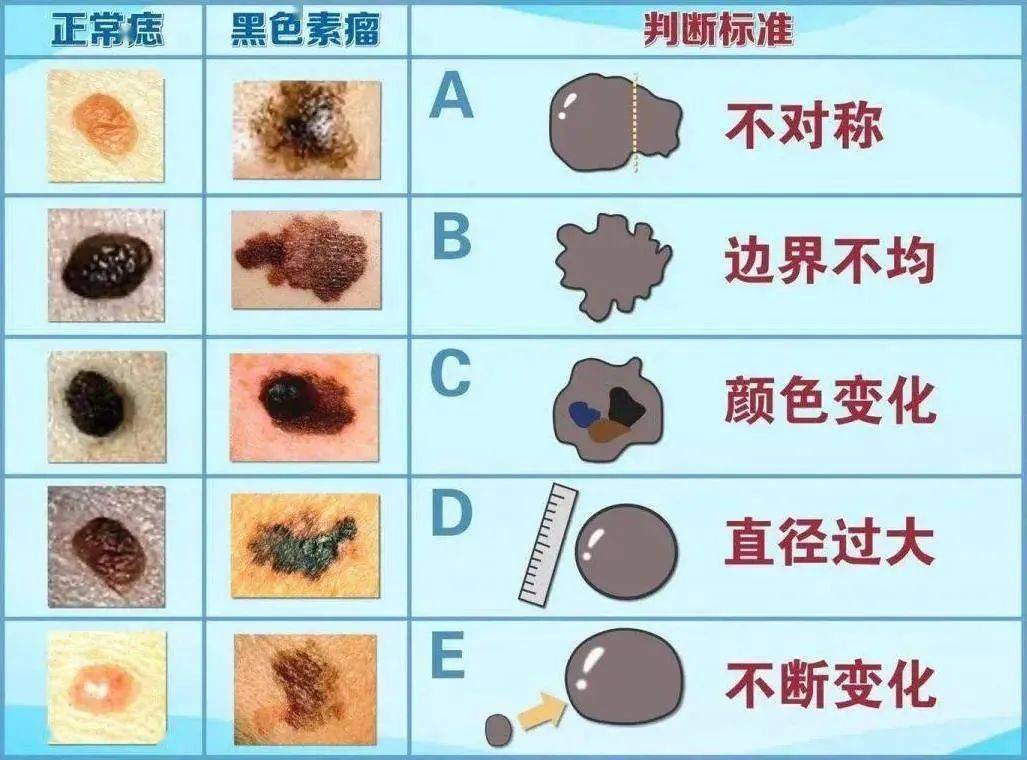 小孩痣图解大全图片