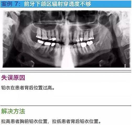 牙科拍摄全景片的10大经典失误案例及原因分析