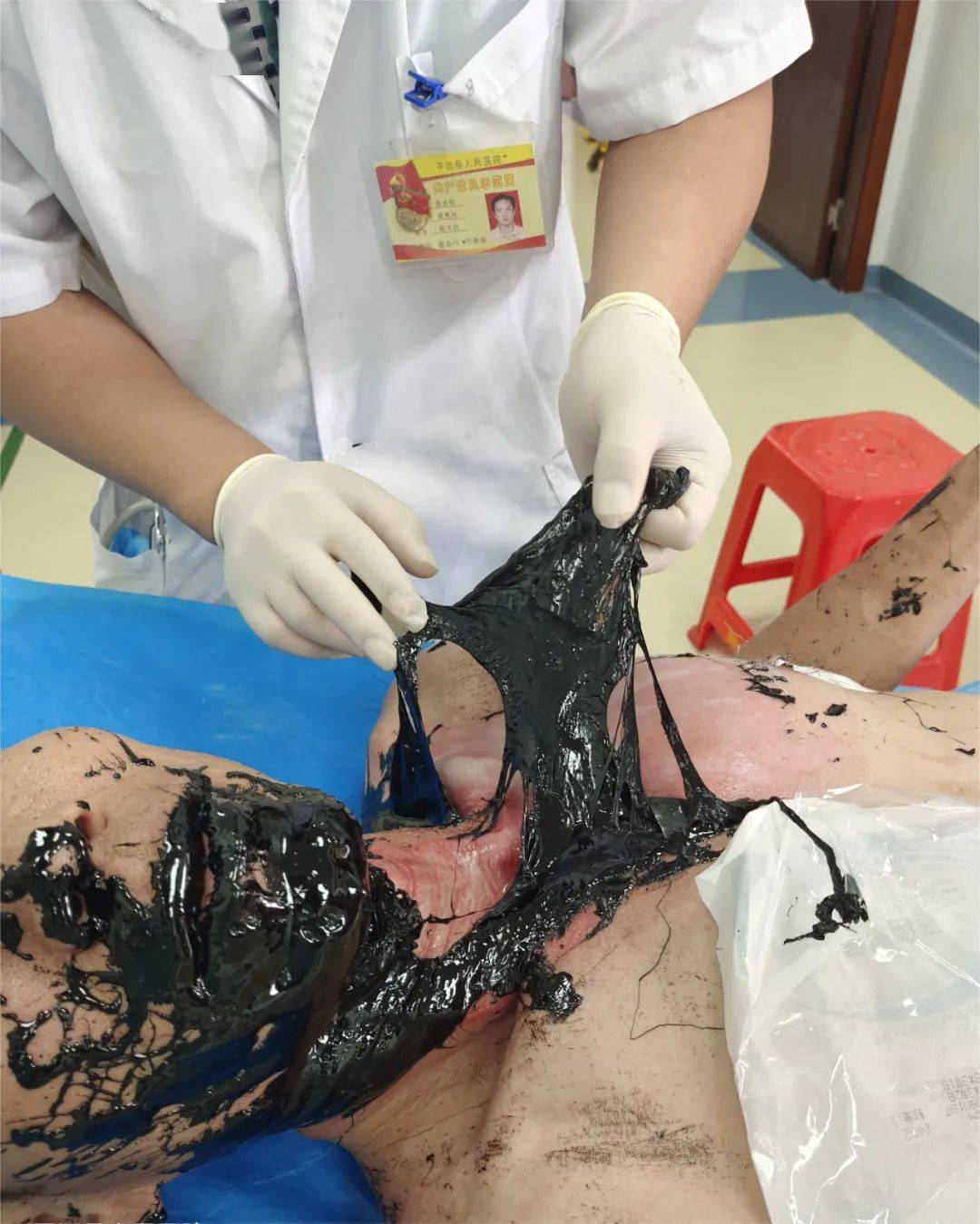 梅州一人被柏油烧伤!画面触目惊心.