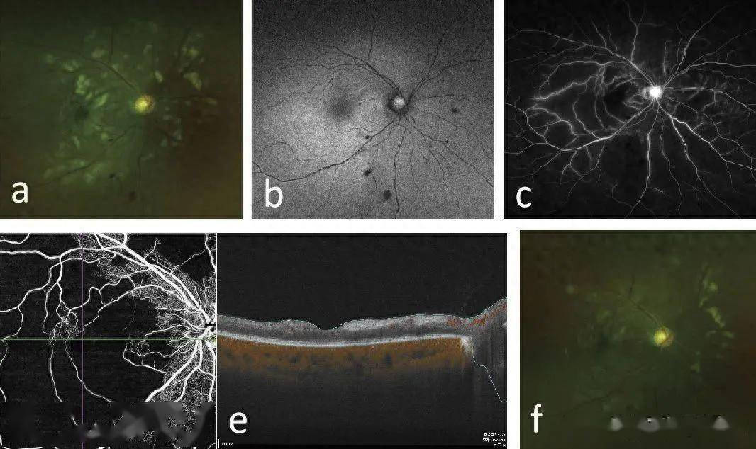 协和团队发现sle患者purtscher样视网膜病变的全身危险因
