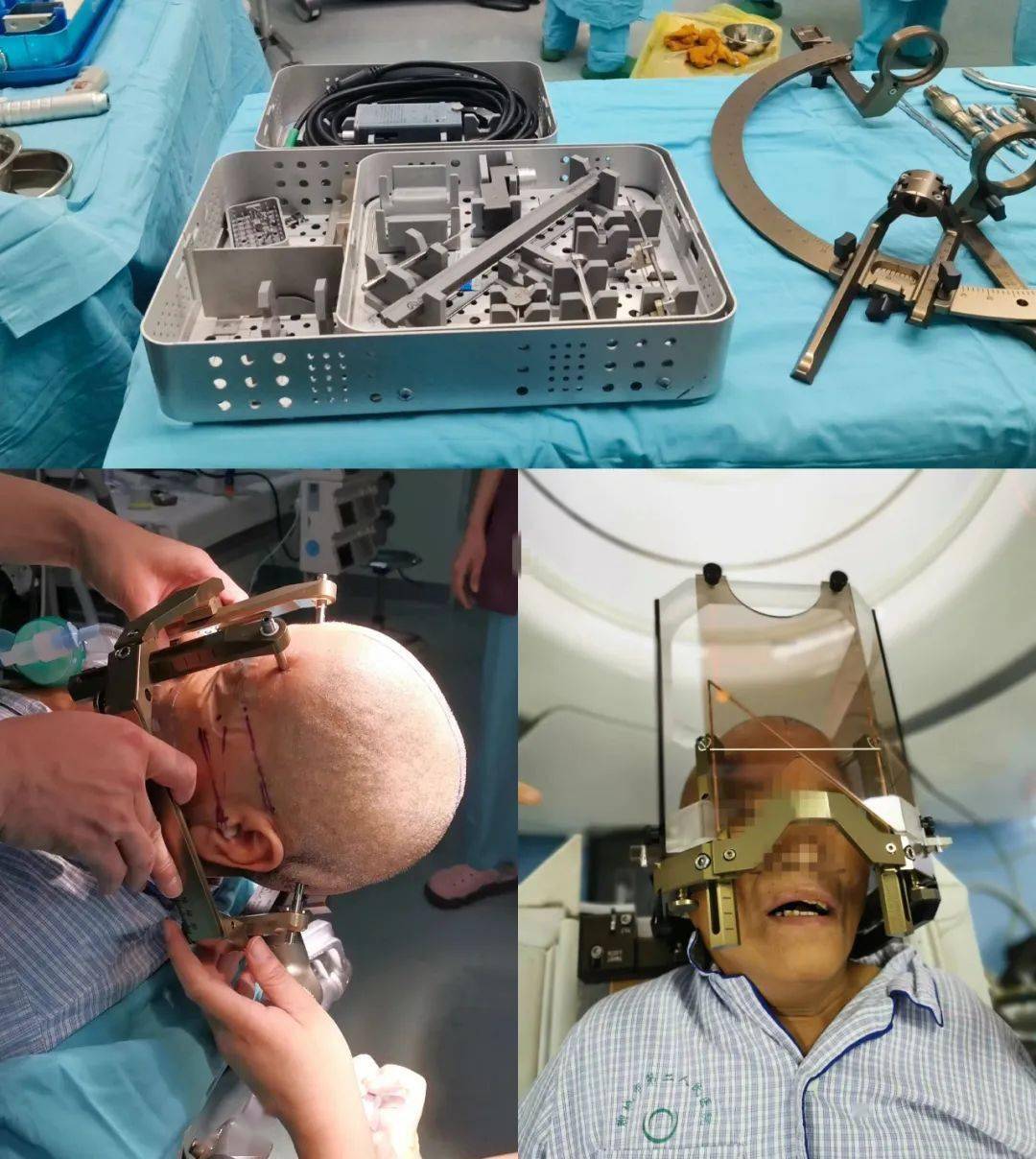 聊城市二院成功开展医院首例脑起搏器植入术(dbs)_治疗_手术_患者