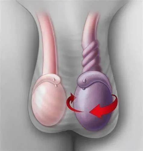 青少年"蛋疼",小心是睾丸扭转!_手术_治疗_阴囊