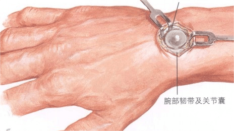 腱鞘囊肿的位置图图片