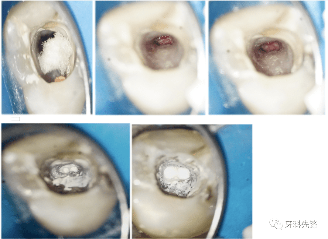 【病例】上(牙合)第二磨牙根尖屏障术一例_治疗_诊断_口腔