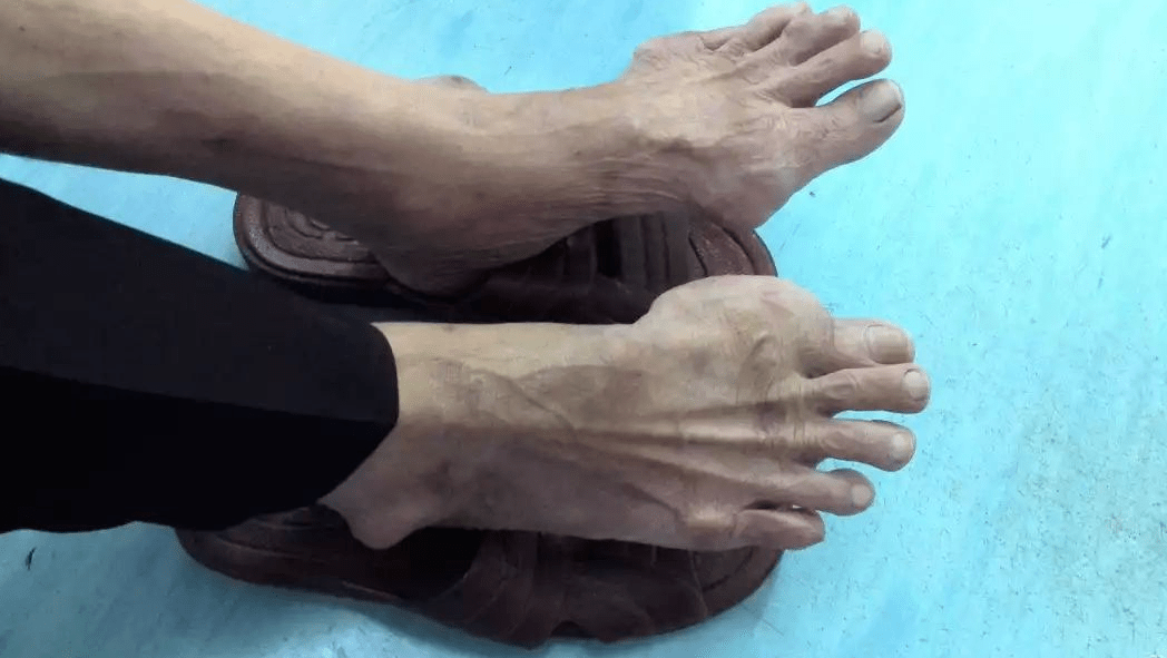 随后,院长许明义通过手术切除了小奇脚趾上的痛风石.