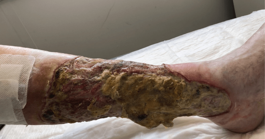 使用蛆虫清创和高压氧治疗难治性坏疽性脓皮病