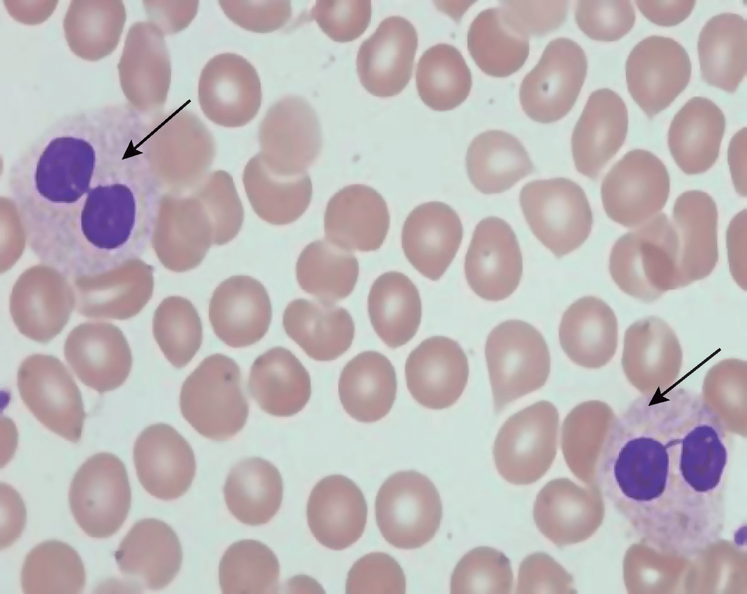 如何識別白細胞病理形態異常_中性_血細胞_顆粒