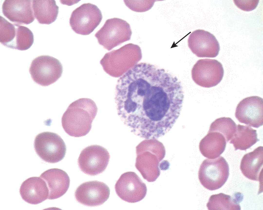 如何识别白细胞病理形态异常_中性_血细胞_颗粒
