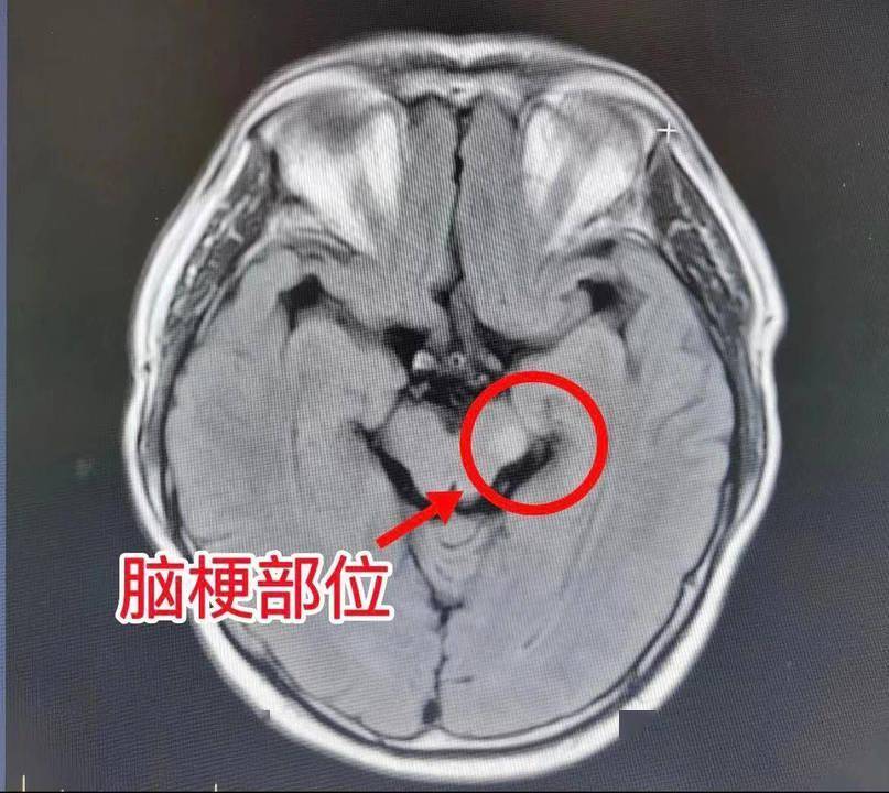 患者脑桥左侧区,胼胝体压部,左侧半卵圆中心新近脑梗死;右侧基底节区