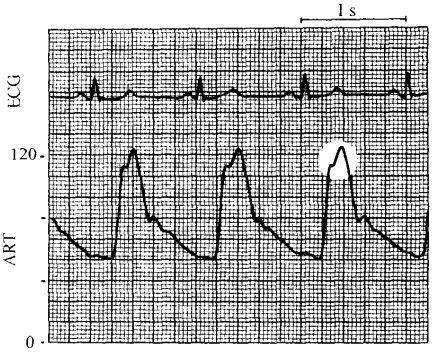 循环监测 | 心脏瓣膜病的血流动力学表现_曲线_患者_二尖瓣