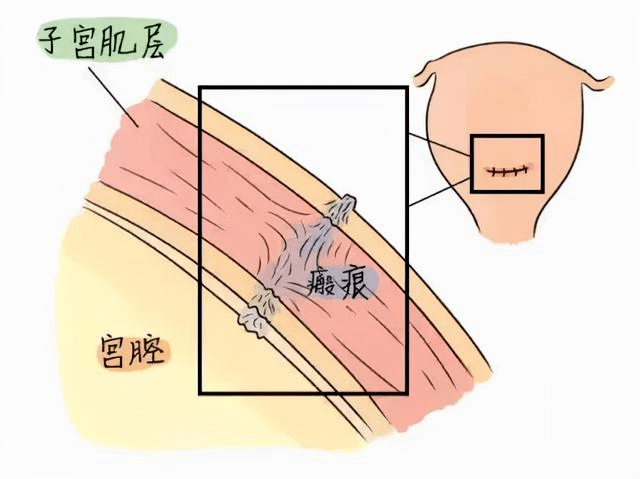 顺产后宫颈图片图片