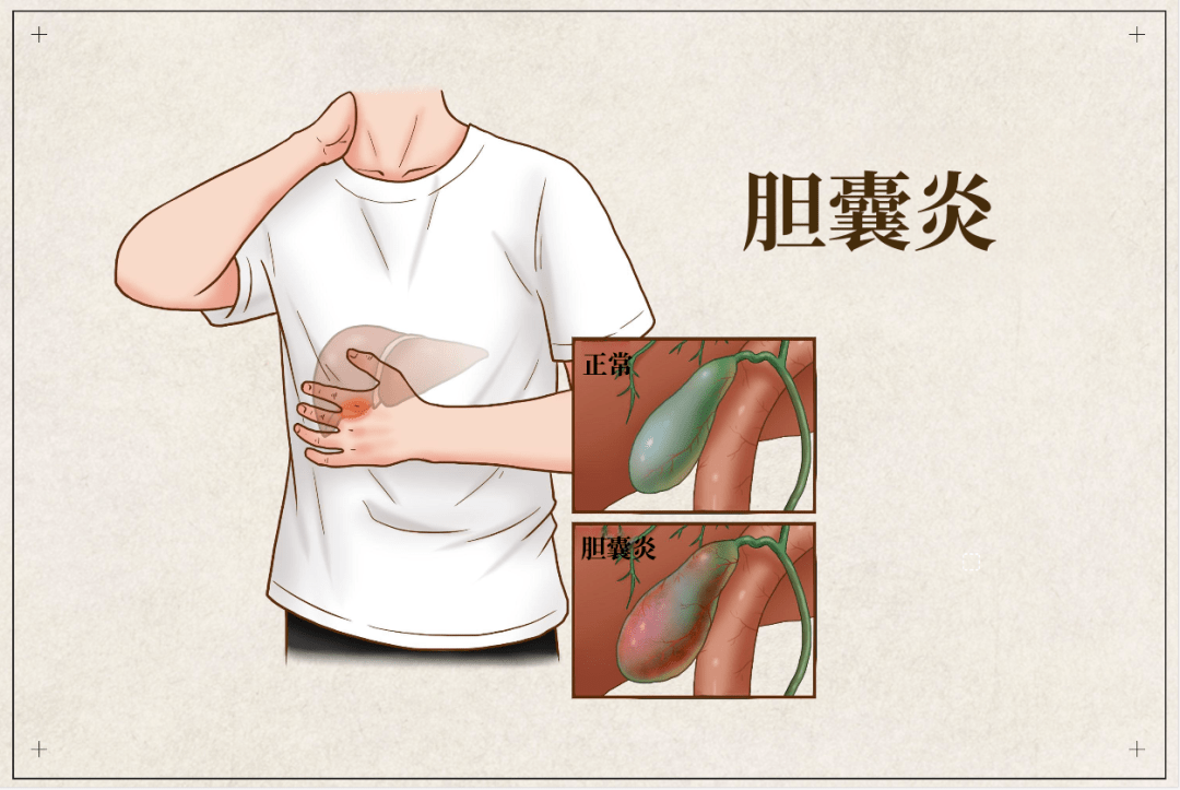 百岁老人突发急性胆囊炎一针入胆介入治疗解急救难