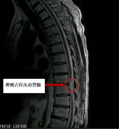 【兰医技术】我院神经外科团队成功切除高难度脊髓肿瘤一例_感觉_手术