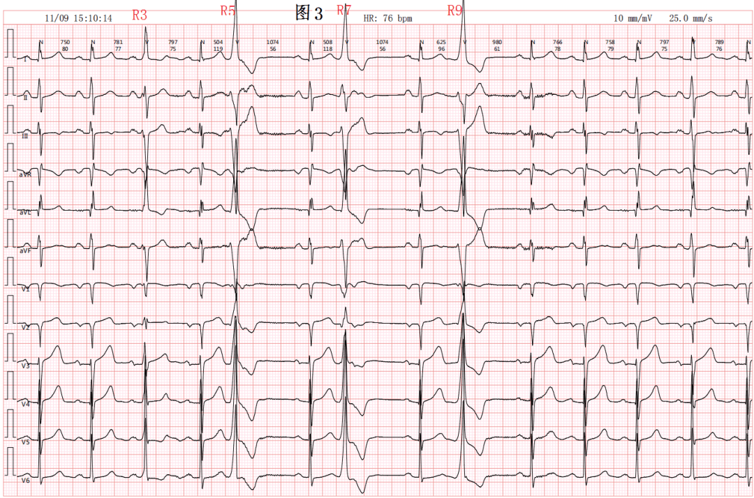 心跳过快心电图图片