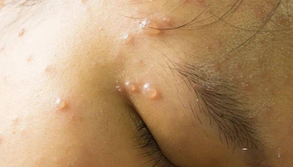 月以来记者了解到诊断为"水痘感染"经专科医生进一步详细检查伴随瘙痒