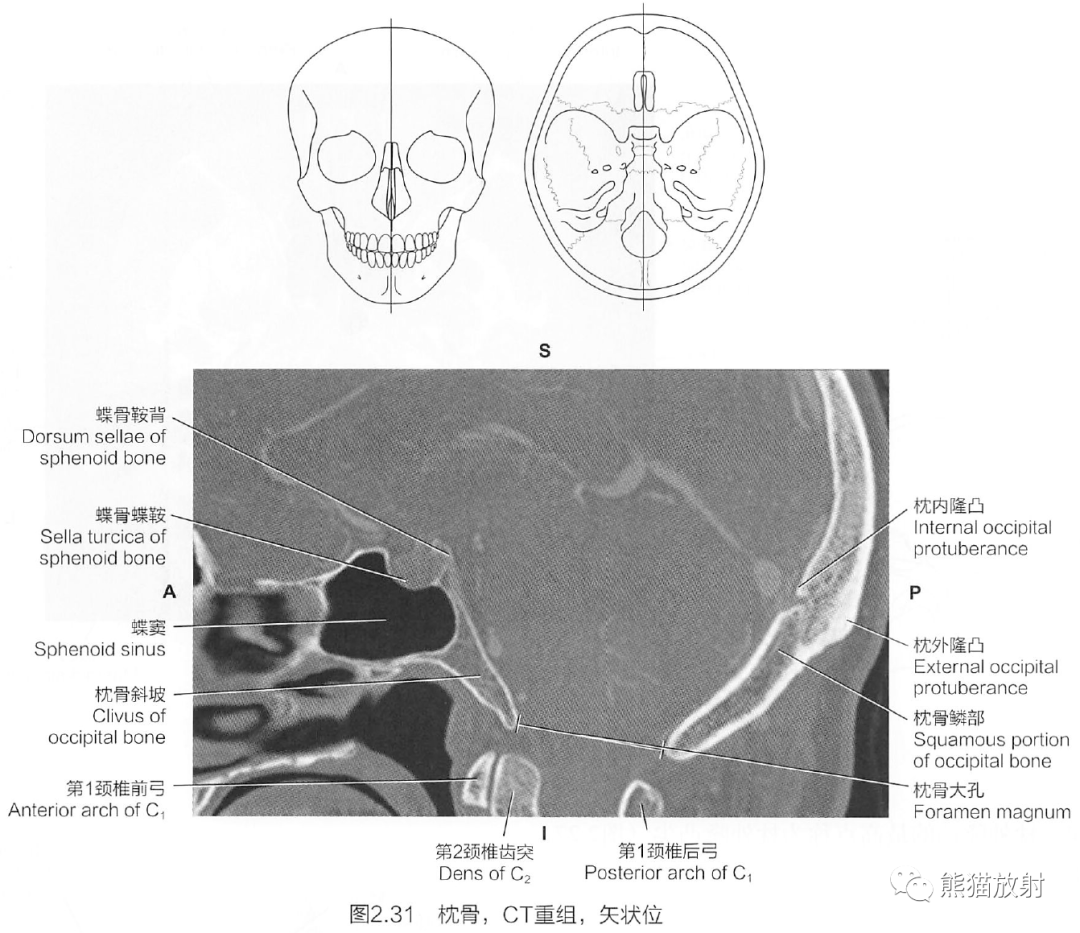 断解选读丨脑颅之蝶骨,枕骨_全网_影像_解剖图