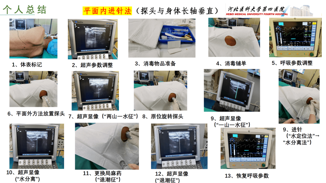 胸椎旁神經阻滯經驗分享(裴煥爽 河北醫科大學第四