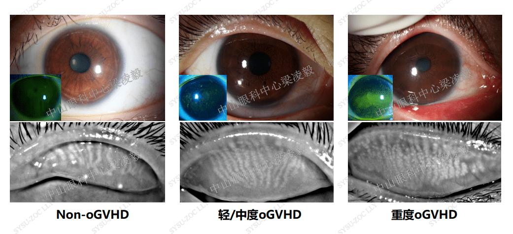 兩組瞼板腺腺泡擴張程度接近.