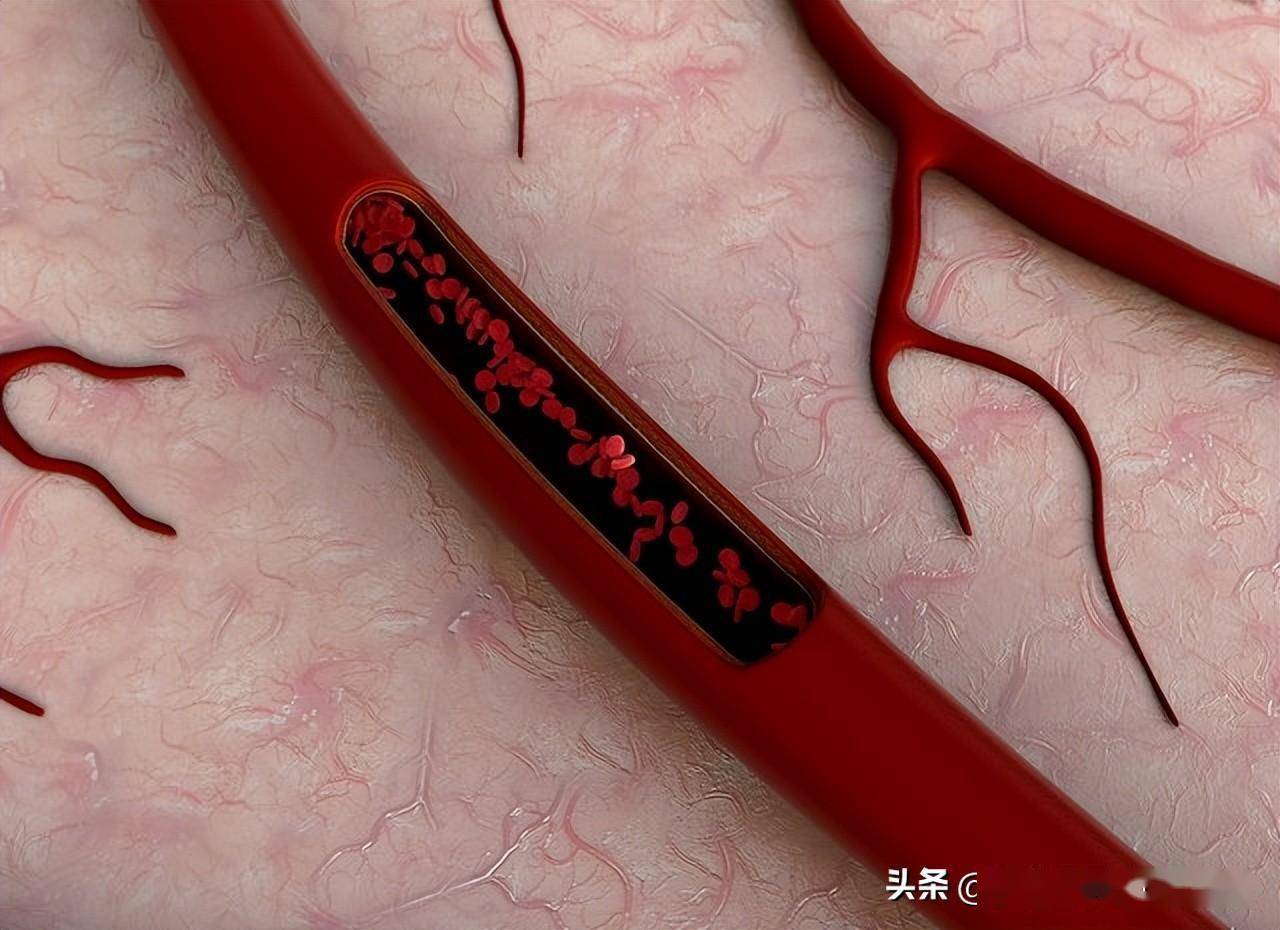 静脉血栓栓塞症(vte)防治