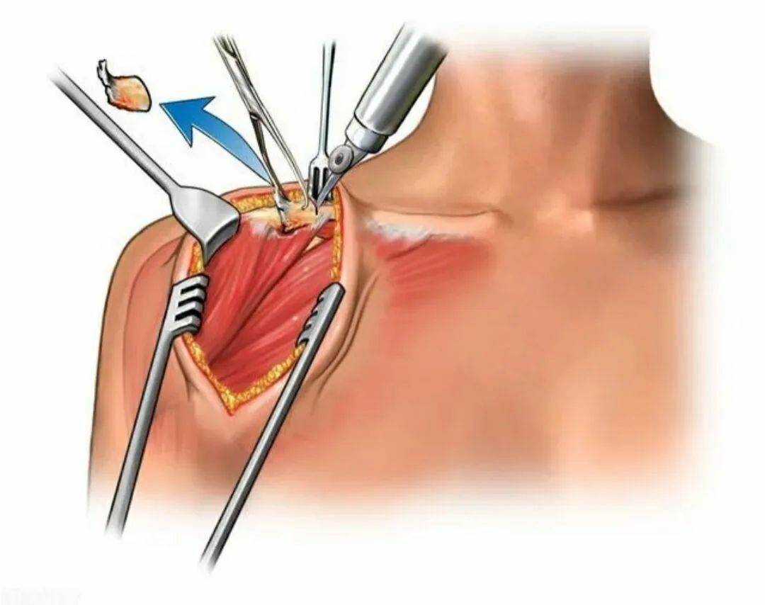肩周炎手术图片
