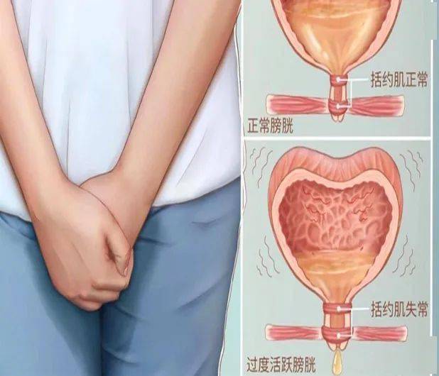 产后「漏尿」太尴尬,你属于哪一类?建议产后妈妈都看看!