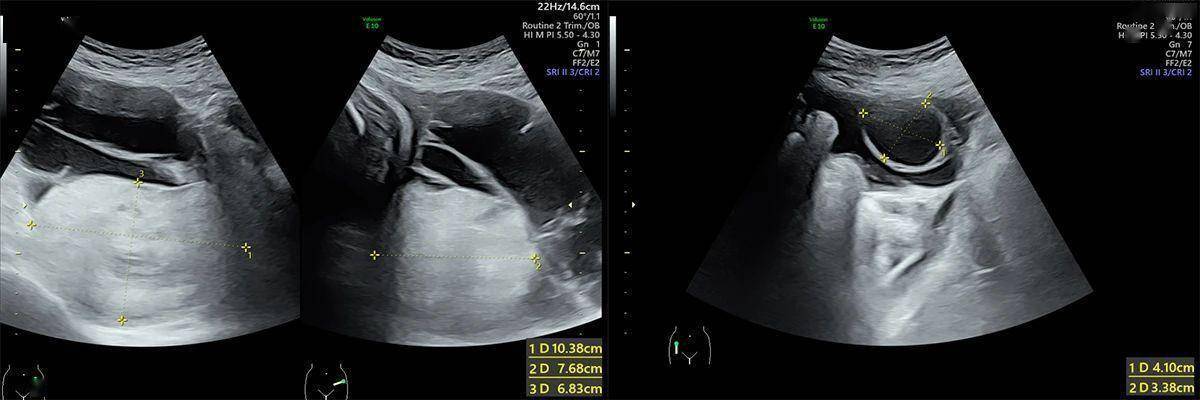 怀孕36周,卵巢肿瘤却比宝宝的头还大,如何实现高难度拆弹?