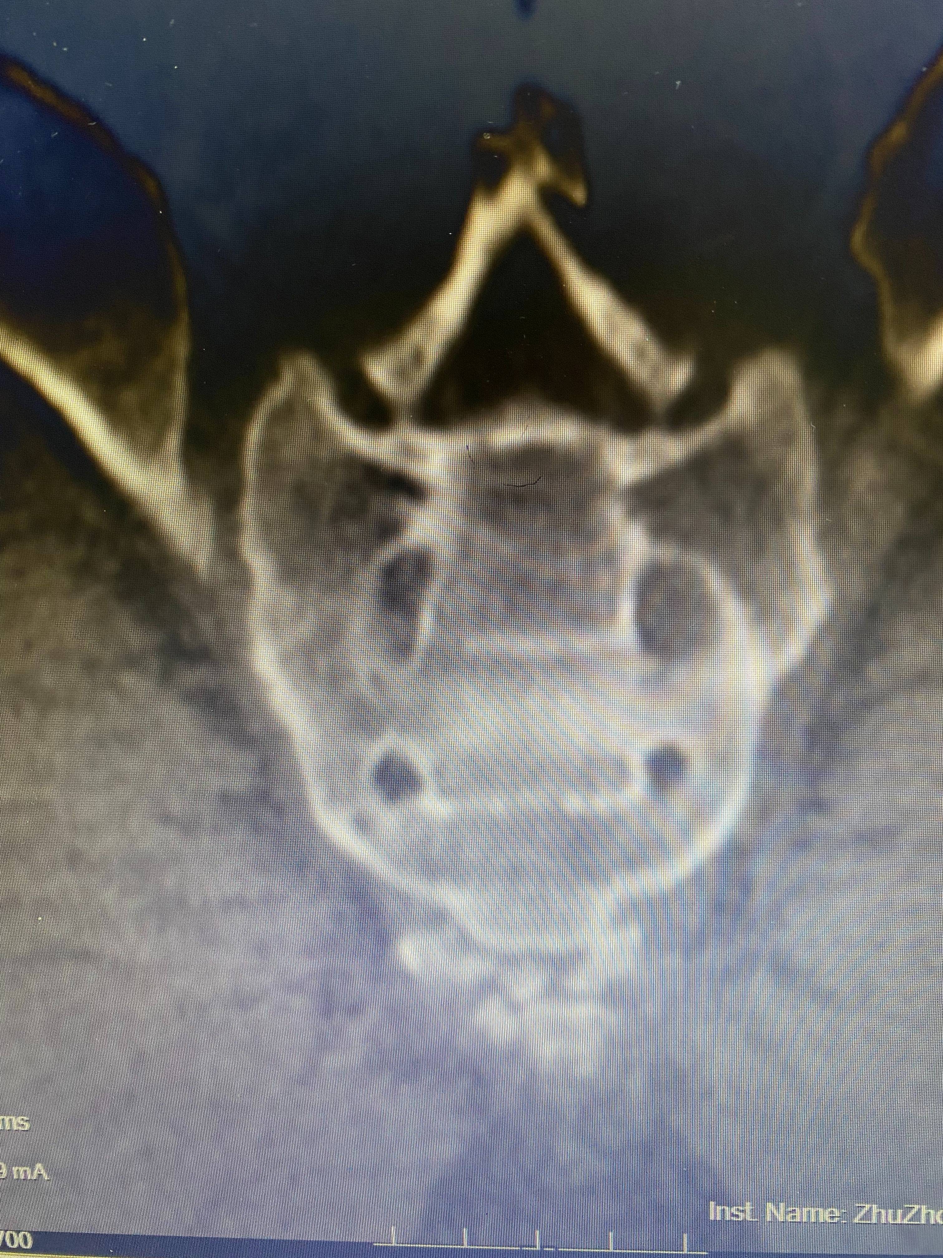 人体尾巴骨骨折图片图片