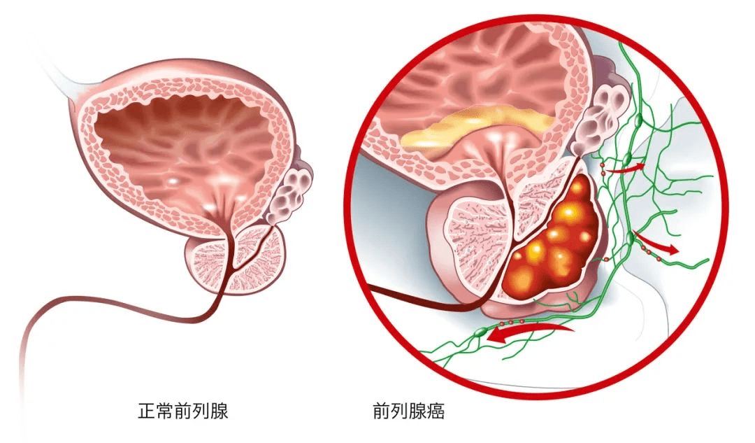 風險分級主要根據psa水平,直腸指診,病理分級,前列腺癌穿刺陽性針數