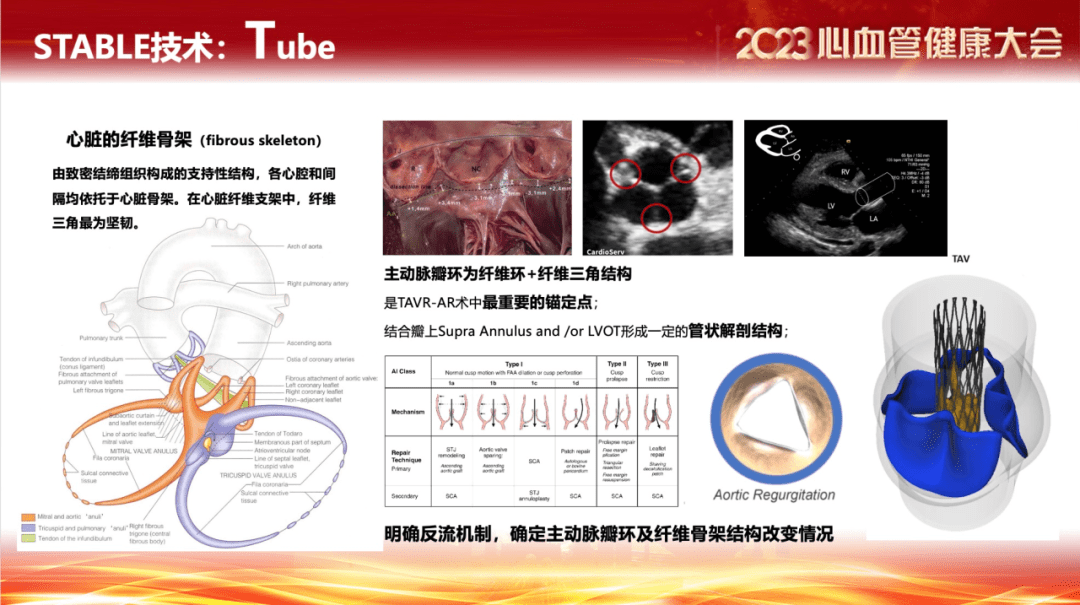 在剛剛結束的2023中國心血管健康大會上,《單純主動脈