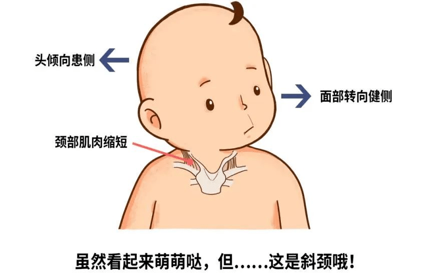 婴儿颈部包块图片