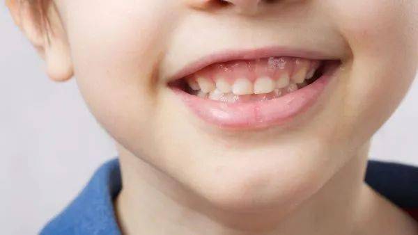 而且有些牙齿问题,比如地包天,龅牙等情况,可能是由颌骨发育异常导致