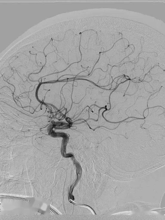 中國神介500人群病例集錦第227期:大腦前動脈取栓3例_造影_症狀_導管