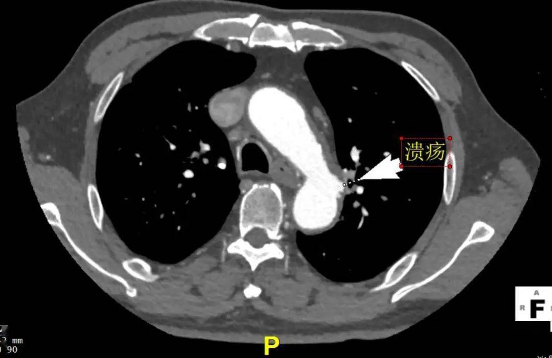 "贞"心一"课"|应用可主动调控胸主动脉覆膜支架治疗穿透性溃疡一例