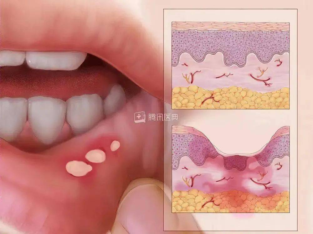 不同类型口腔溃疡图解图片